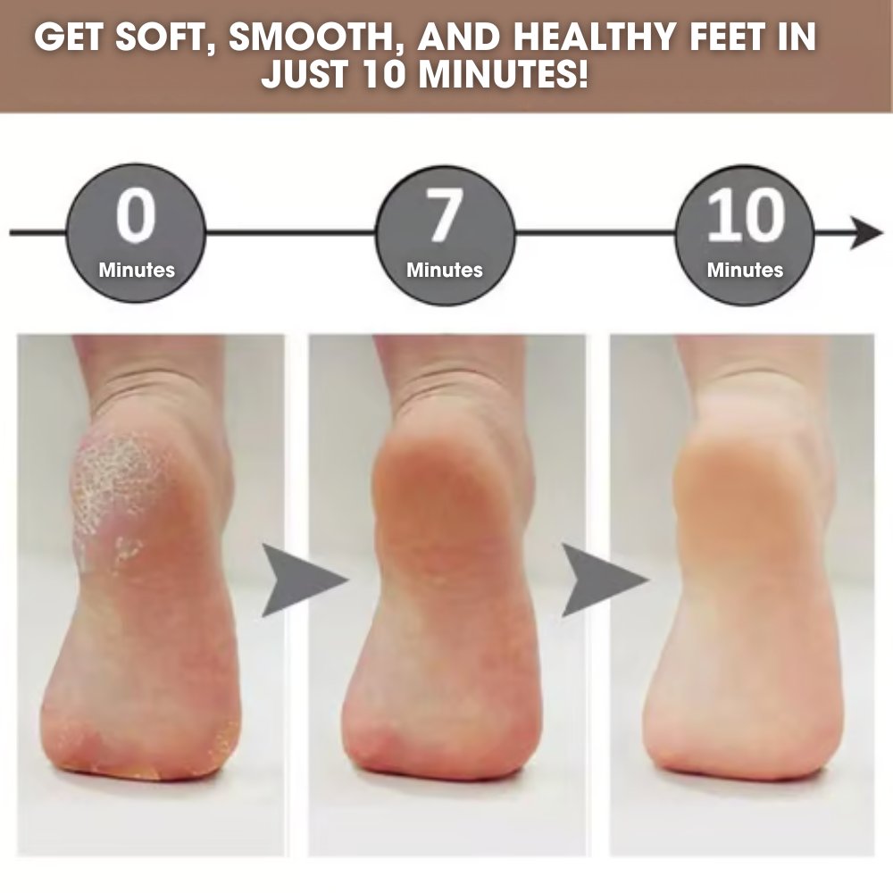 CalluCare™ | Electric callus remover